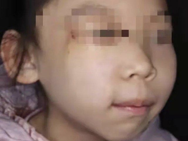 西安一熊猫宝宝脸长巨痣成功换脸，手术的成功有什么意义？