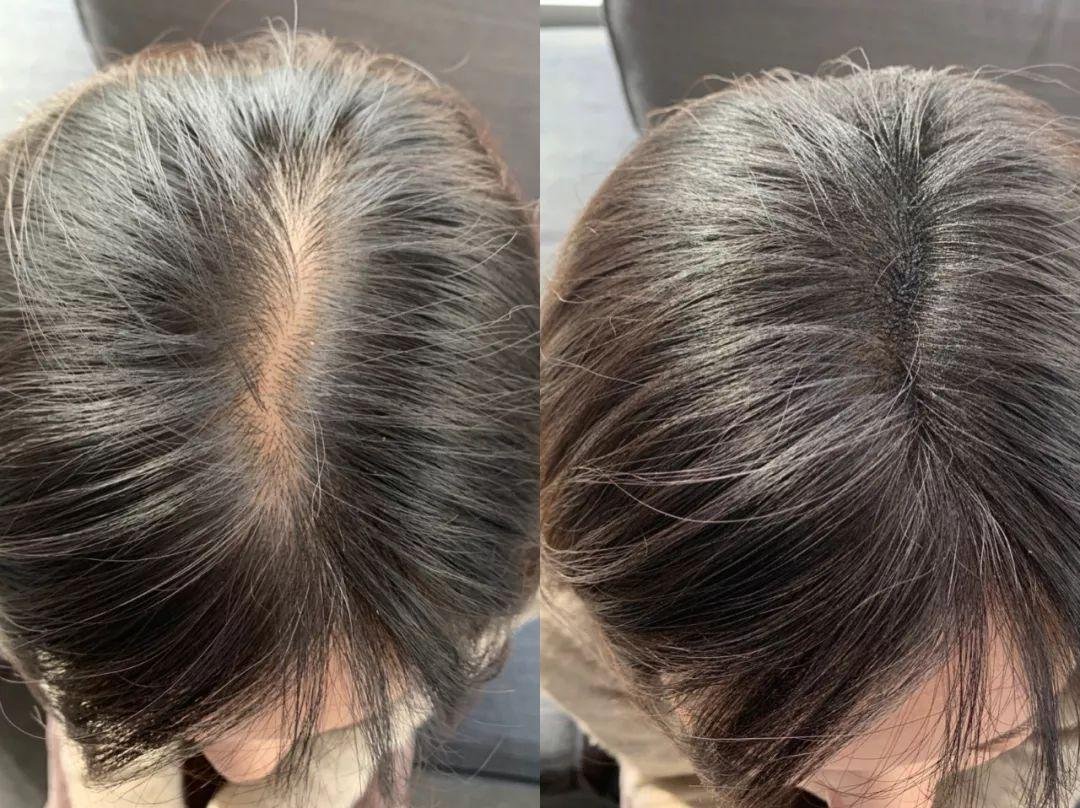 疫情期近6成日本民众有头顶焦虑，专家对此有何表示？