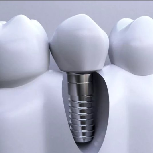 装一颗假牙多少钱啊